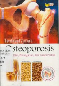 Osteoporosis : Deteksi Dini, Penanganan, dan Terapi Praktis